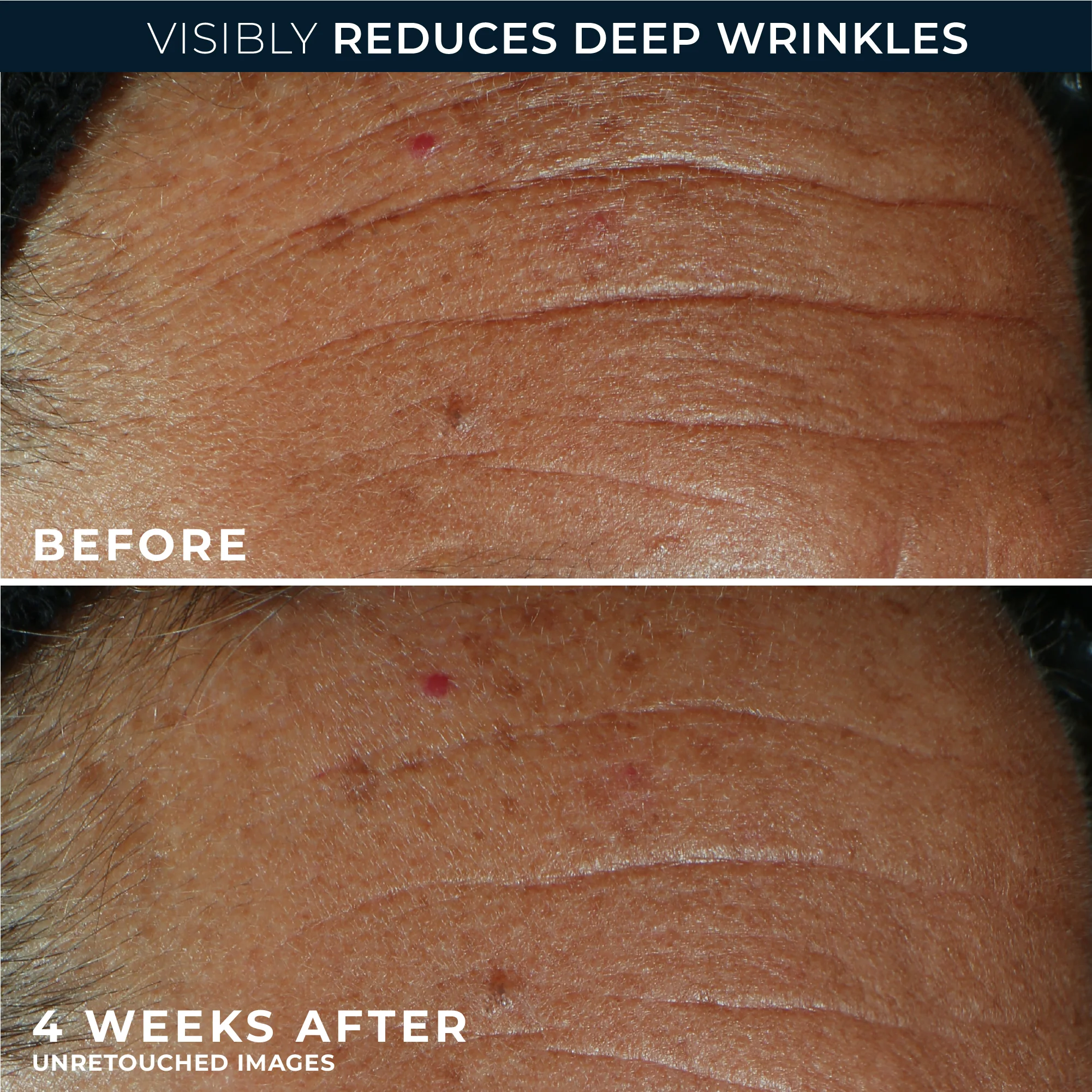 DERM CORREXION® Fill + Treat Serum 5 DERM CORREXION® Fill + Treat Serum