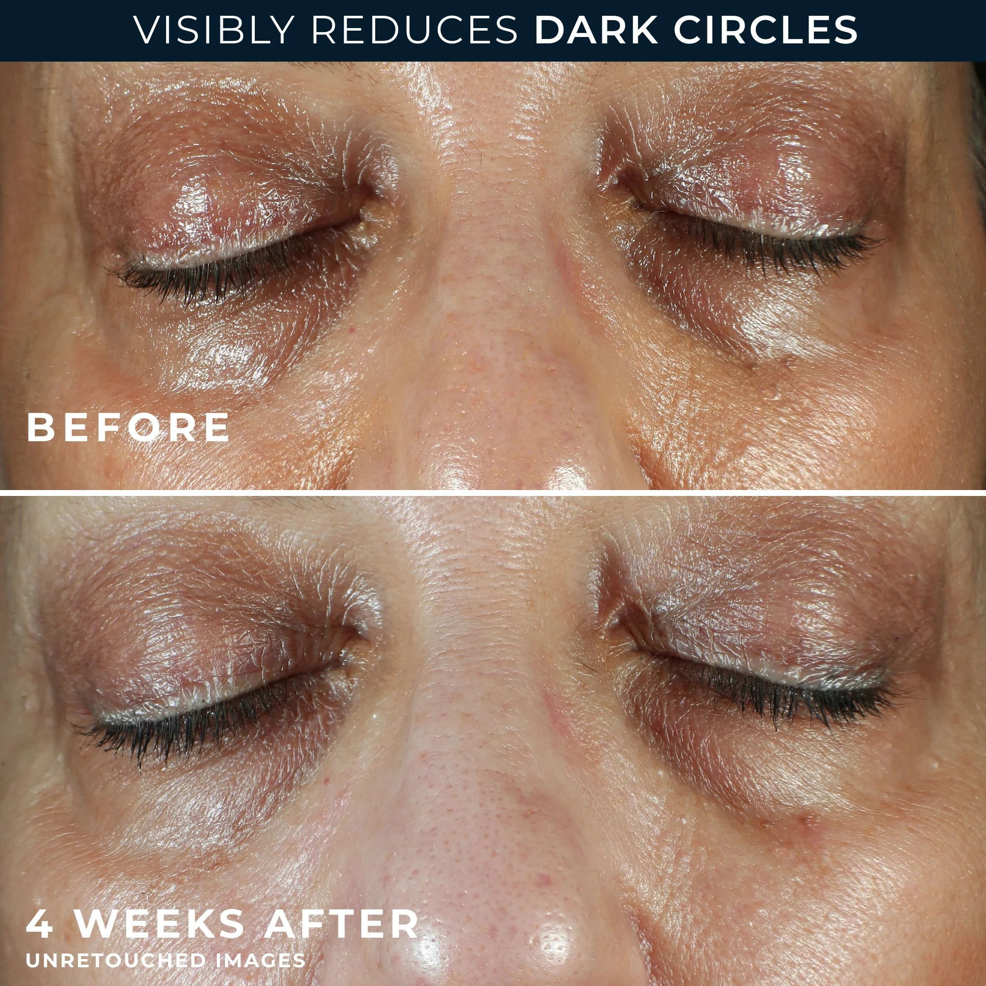 MULTI CORREXION® Even Tone + Lift Eye Cream 5 MULTI CORREXION® Even Tone + Lift Eye Cream